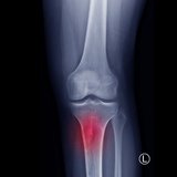 Knie-Röntgenaufnahme zeigt Fibröse Dysplasie (FD)-Erkrankung. FD ist ein gutartiger Tumor, dessen Knochen durch fibröses Gewebe und Expansion ersetzt wird. ©joel bubble ben/shutterstock.com