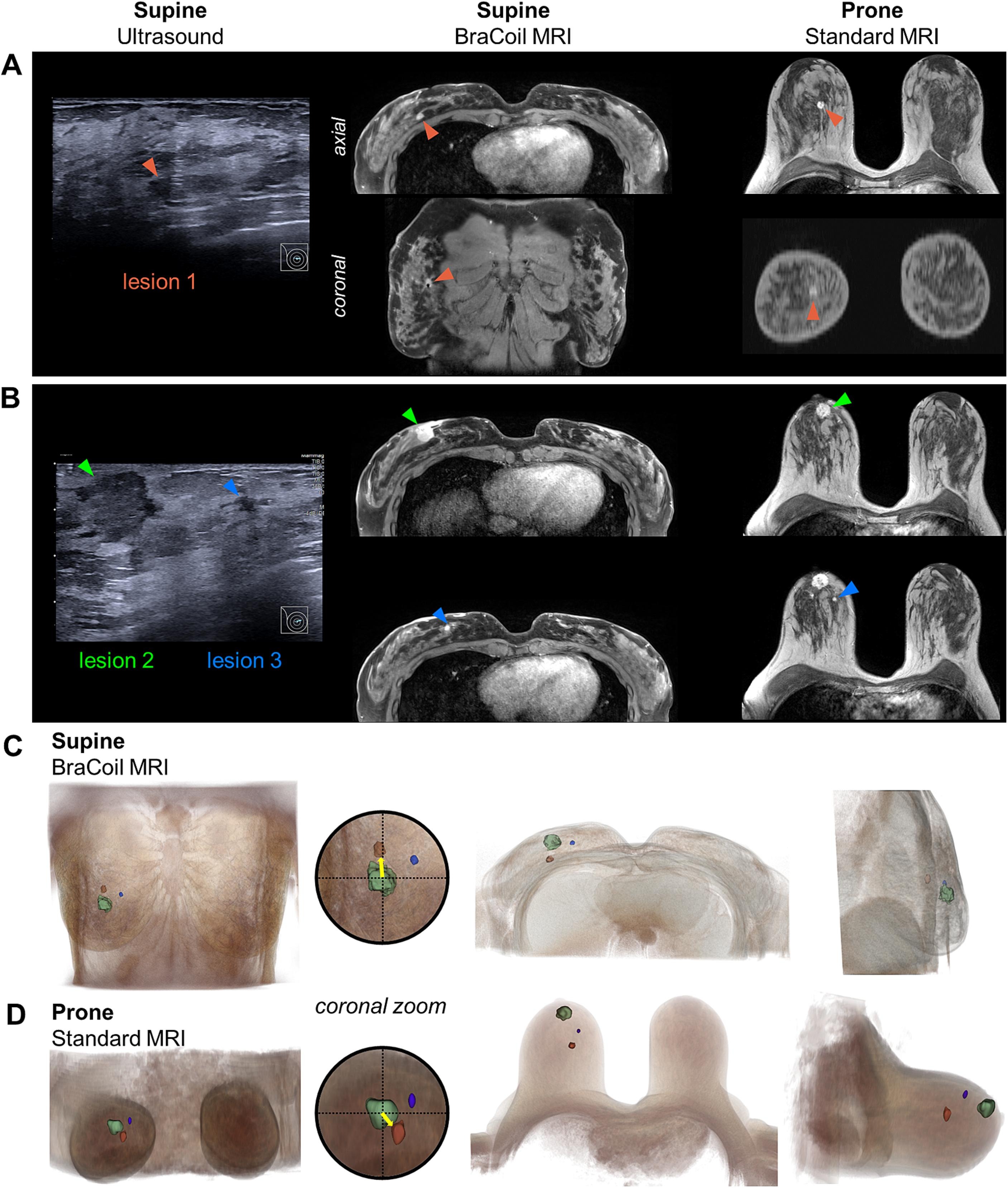 Nohava L, Clauser P, Czerny R, Baltzer PAT, Laistler E. Supine breast MRI using a wearable coil facilitates the translation of MR imaging findings to clinical practice. Eur J Radiol. 2025;184:111974. doi:10.1016/j.ejrad.2025.111974. ©ELSEVIER